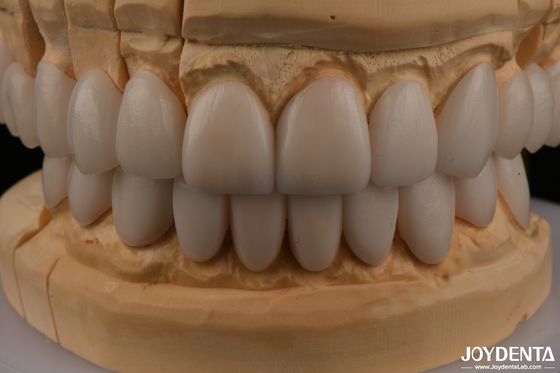 खरीदें 0.3 मिमी मोटाई Ips Emax Veneers सिरेमिक Veneers सामने पीछे की बहाली ऑनलाइन निर्माण