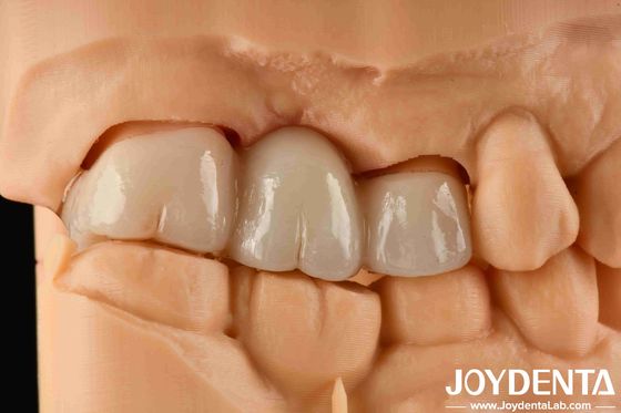 खरीदें अनुभव रंग यथार्थवादी पूर्ण जिरकोनिया 1000 एमपीए के दाग और झुकने की ताकत के लिए उच्च प्रतिरोध के साथ ऑनलाइन निर्माण