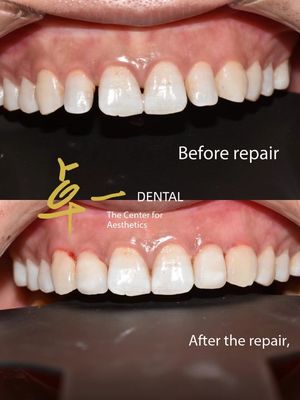 खरीदें एक बेदाग मुस्कान को कॉस्मेटिक डेंटल फ़नीर के साथ नमस्कार कहें कोई विरूपण नहीं कोई तैयारी नहीं ऑनलाइन निर्माण