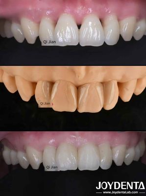 खरीदें प्राकृतिक पारदर्शी दांतों के लिए एकदम सही समाधान ऑनलाइन निर्माण