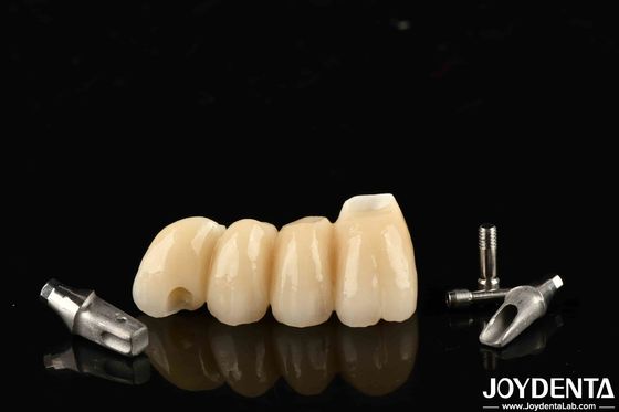 खरीदें अनुकूलन योग्य इम्प्लांट मुकुट और पुलों ऑनलाइन निर्माण