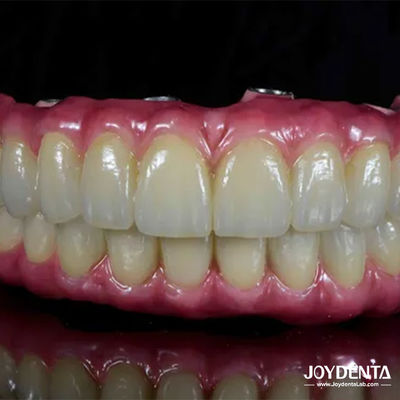 खरीदें हल्के दांत टाइटेनियम मलोंग हाइब्रिड ब्रिज दांतों की बहाली के लिए आरामदायक ऑनलाइन निर्माण