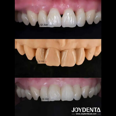 खरीदें प्राकृतिक पारदर्शी दांतों के लिए एकदम सही समाधान ऑनलाइन निर्माण