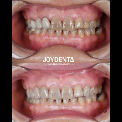 खरीदें इष्टतम रोगी अनुभव के लिए हल्के दंत जिरकोनिया प्राकृतिक रंग संक्रमण और जैव संगतता की गारंटी ऑनलाइन निर्माण