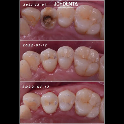 खरीदें दांतों को ठीक से फिट करने के लिए दांतों का पोर्सिलेन ऑनलाइन निर्माण