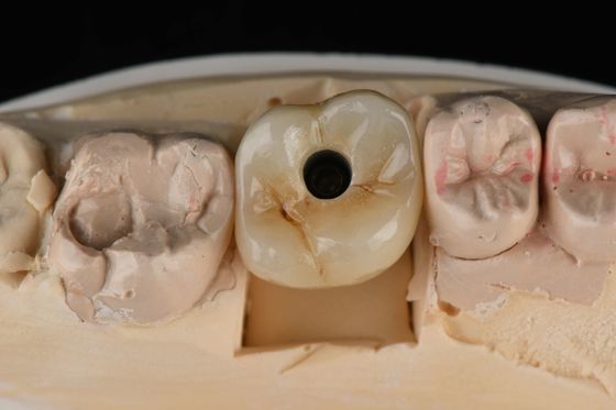 टाइटेनियम 10 मिमी एकल दांत दंत प्रत्यारोपण प्रतिस्थापन Abutment स्वयं टैपिंग Sandblasted