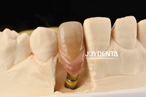 0° कोण समाप्त दंत Abutments 1.5 मिमी धागा पिच पॉलिश सतह
