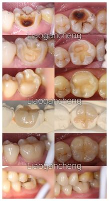 वयस्क और बच्चों के लिए पोर्सिलेन डेंटल इनले रेस्टोरेंट