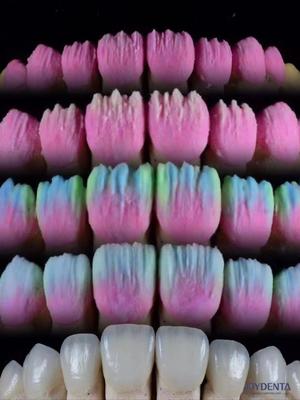 The Joydenta Ceramic Veneer Process