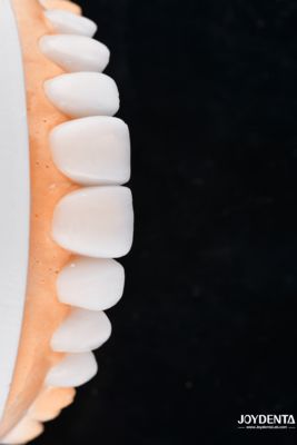 Enhance Case Acceptance & Patient Communication with Our Diagnostic Wax-Up Service