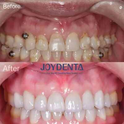 टूटे हुए दांतों के लिए दंत फोनेर ∙ ग्लोबल प्रीमियम डेंटल लैब सेवाएँ