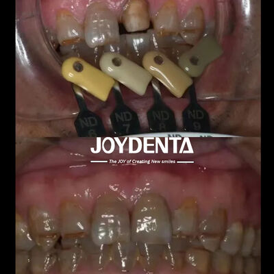 पारदर्शी जिरकोनिया मुकुट बहुस्तरीय ढाल प्रौद्योगिकी