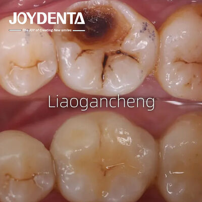 वयस्क और बच्चों के लिए पोर्सिलेन डेंटल इनले रेस्टोरेंट