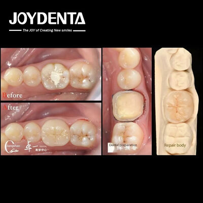 जैव संगतता और प्राकृतिक दांतों की बहाली के साथ उच्च संगतता